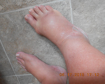 Rufina's-swollen-legs